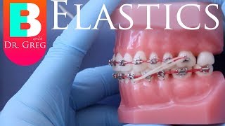 BRACES EXPLAINED Elastics  Rubber Bands [upl. by Eetsud585]