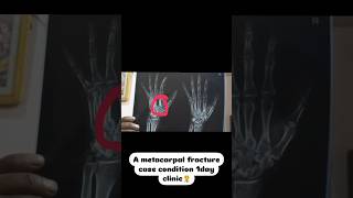 Metacarpal feature 😨😱 tretment physiotherapy explore fyp trending pain massage shorts [upl. by Crisey]