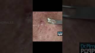 Dr Pimple Popper Goes Digging [upl. by Faina415]