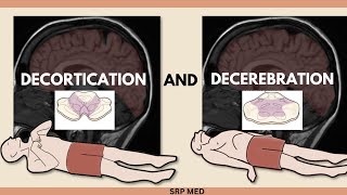 Decerebration vs Decortication  Understanding Neurological Postures amp Brain Damage [upl. by Lellih855]