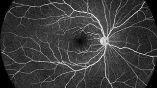 Fundus fluorescein angiography FFA [upl. by Varian]