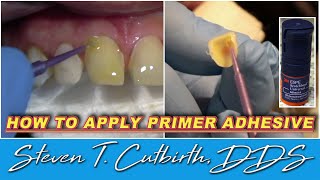 How to Apply Primer Adhesive When Seating Veneers  Dental Minute with Steven T Cutbirth DDS [upl. by Strait]