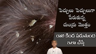 Solution for Dandruff  Get Rid of Dandruff  Thick Hair  Dr Manthenas Health Tips [upl. by Dalli142]