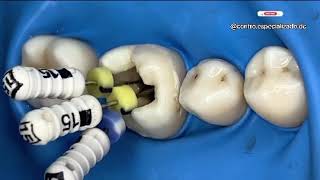 “LIMAS de endodoncia para eliminar el nervio de las muelas RCT” [upl. by Aneehsyt]