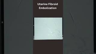 Uterine Fibroid Embolization [upl. by Burkhardt]