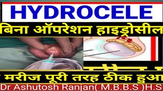 Hydrocele ka ilaj बिना operation hydrocele का मरीज पूरी तरह ठीक urology [upl. by Ellevel]