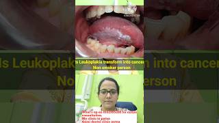 White patch in mouthLeukoplakia in Non smokersLeukoplakia amp smokingWhen Leukoplakia is dangerous [upl. by Schecter620]