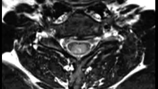 Spinal Ependymoma [upl. by Aidua]