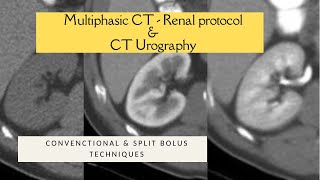 MULTIPHASIC RENAL CECT PROTOCOL  SPLIT BOLUS TECHNIQUE CT UROGRAPHY Triple bolus technique [upl. by Lamaj]