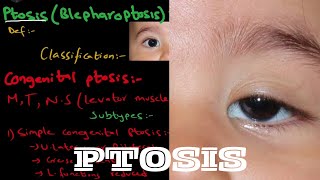 What is Ptosis  Droopy eyelid   it’s types and treatment  detailed explanation [upl. by Notneb]