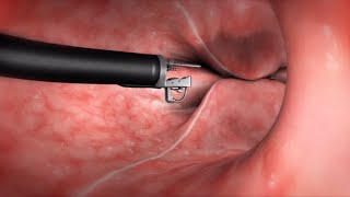 What Happens During the Endoscopic Sleeve Gastroplasty ESG Procedure [upl. by Bechler]