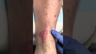 Venous Eczema a Common Cause of Red Itchy Skin on the Lower Leg [upl. by Aduh]