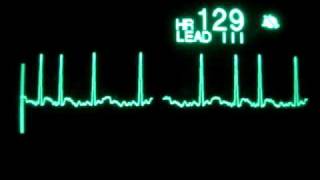 Atrial Fibrillation with RVR [upl. by Venus]