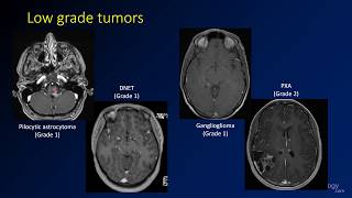 Imaging brain tumors  4  Other low grade gliomas [upl. by Eadrahc]