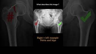 Right v left example  Pelvis and hips 11 Musculoskeletal Xray Viewing radiologychannel007 [upl. by Ainesy820]