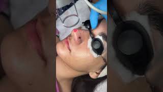 Wart Removal treatmentBy CO2 laser treatmentSkin smile clinic Bhopal wart wartremoval [upl. by Idelson11]