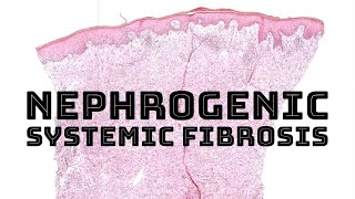 Nephrogenic systemic fibrosis from Gadolinium MRI contrast pathology dermatology dermatopathology [upl. by Otter]