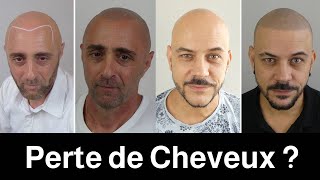 La technique parfaite pour moi La Dermopigmentation des cheveux [upl. by Assirak]