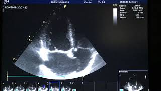 Atrial septal aneurysm [upl. by Eelsew972]