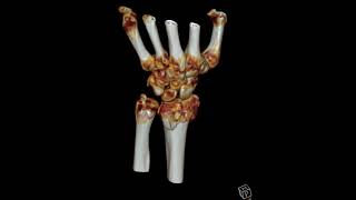 Comminuted distal radius fracture [upl. by Alasdair204]