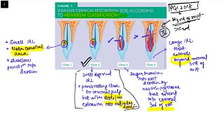 Heithersay Classification of invasive cervical resorption INICET MDS NEET MDS [upl. by Ahsocin]