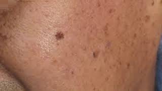 MULTIPLE SEBORRHEIC KERATOSIS REMOVAL FROM FACE [upl. by Kenton]