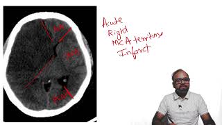 SPOTTERZ  03  Brain hypodensity in a typical vascular territory [upl. by Alakam]