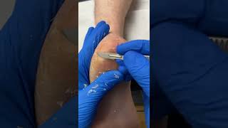 Join Australian podiatrist on a dry heel callus removal journey FootHealth PodiatryMagic [upl. by Namrac348]