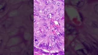 Secretory Carcinoma [upl. by Zeuqcaj]