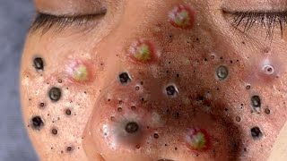 Big Cystic Acne Blackheads Extraction Blackheads amp Milia Whiteheads Removal Pimple Popping  8196 [upl. by Ennaira81]