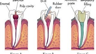 4 Root Canal Alternatives [upl. by Goldstein]