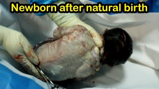 Angry newborn baby girl was born by a difficult natural delivery [upl. by Ahsikin]