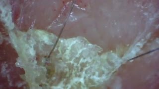 Peeling Scabs Under Magnification [upl. by Rockie485]