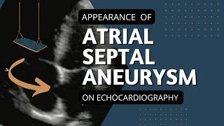 Atrial Septal Aneurysm looks like a swing on Echocardiography cardiology echo swing [upl. by Sorci925]