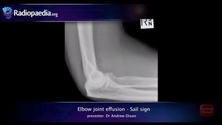 Elbow joint effusion and the sail sign  radiology video tutorial xray [upl. by Cyrano]