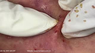 Big Cystic Acne Blackheads Extraction Blackheads amp Milia Whiteheads Removal Pimple Popping [upl. by Prudy246]