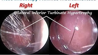 Nose Endoscopy  Rhinitis Medicamentosa Drug Induced RhinitisTopical Nasal Decongestants [upl. by Bettencourt109]