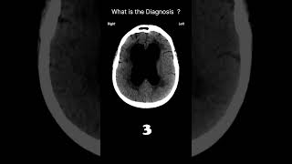 Hydrocephalus  CT brain Acute CT Brain Brain volume 55 radiologychannel007 [upl. by Ellesirg]