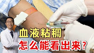 血液粘稠，真会导致心梗和脑梗吗？到底什么是“血稠”？医生讲解 [upl. by Drue]