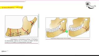 Mandibular Fractures  Part 2 MANAGEMENT [upl. by Ika496]