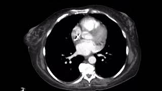 Hepatic artery Pseudoaneurysm [upl. by Slyke]