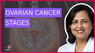 The 4 Stages of Ovarian Cancer by Dr Ruchi Garg [upl. by Yesima]