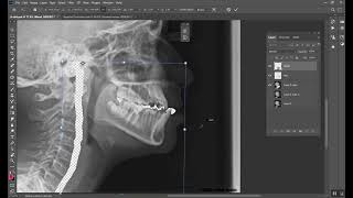 Treatment of Class III malocclusion المرحلة الخامسة [upl. by Nadeen61]