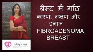 FIBROADENOMA BREAST ब्रैस्ट में गाँठ कारण लक्षण और इलाज  Dr Dipti Jain Ahmedabad [upl. by Einalem880]