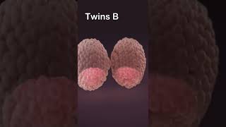 Fraternal Twins Pregnancy  Pregnancy wikihealth shortvideo baby shorts short [upl. by Alit]