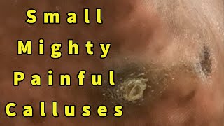 Small Mighty Painful Calluses Intractable Plantar Keratoses Removal  Repost [upl. by Iraam]