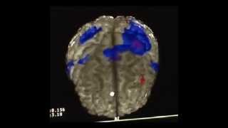 Kinesio effect on cortical brain activity fMRI [upl. by Nyrak]