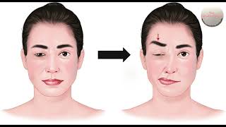 Treatment of Hemifacial Spasm amp Benign Essential Spasm with Botulinum Toxin Injections in India [upl. by Aleil]