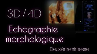 Cas clinique  Echographie Obstétricale morphologique du deuxième trimestre 3D  4D  GH [upl. by Waylan844]