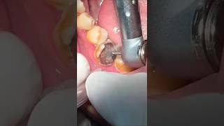 Teeth cavity cleaning 🧹shorts shortsfeed teeth [upl. by Spear382]